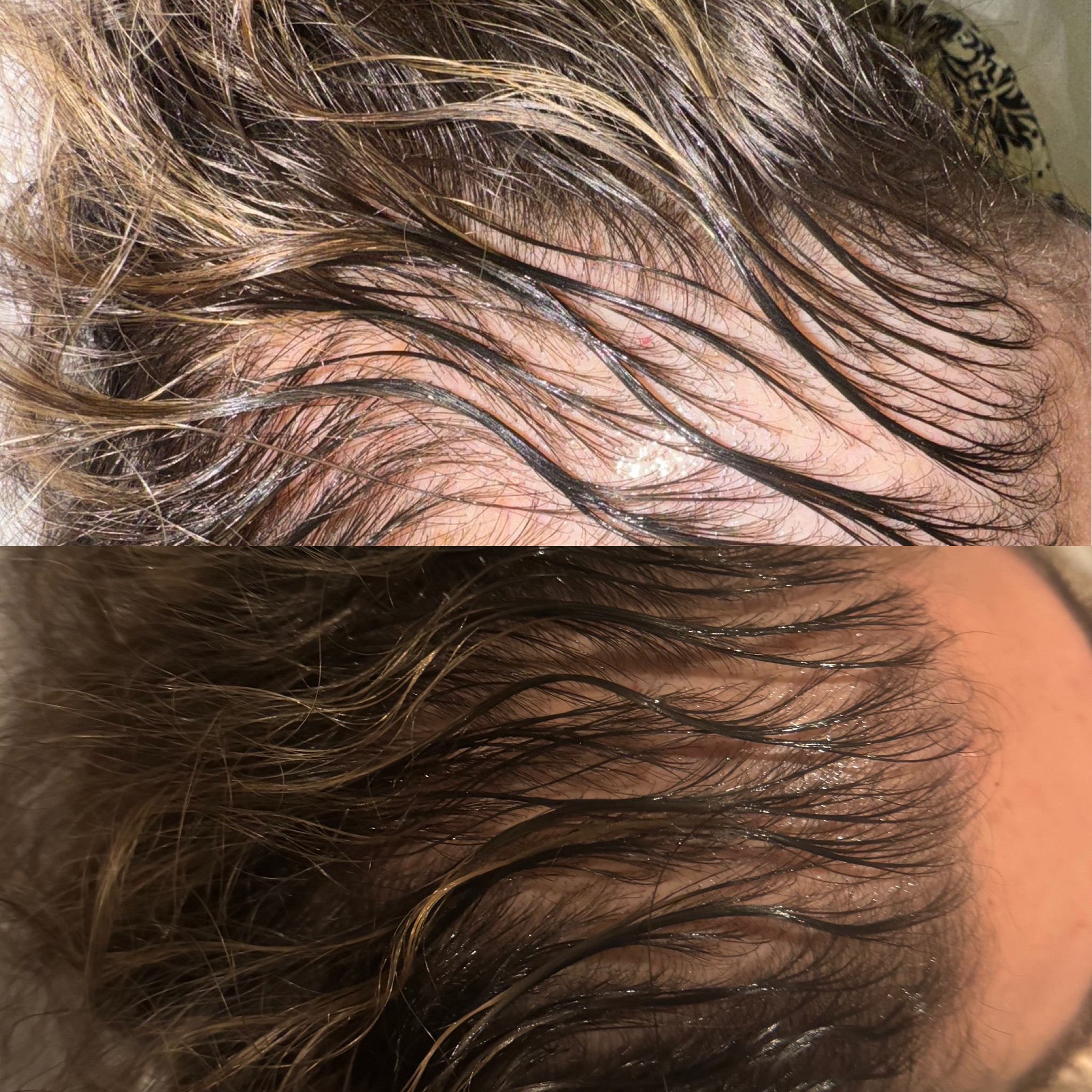 Before and after PRP hair regeneration - female pattern hair loss
