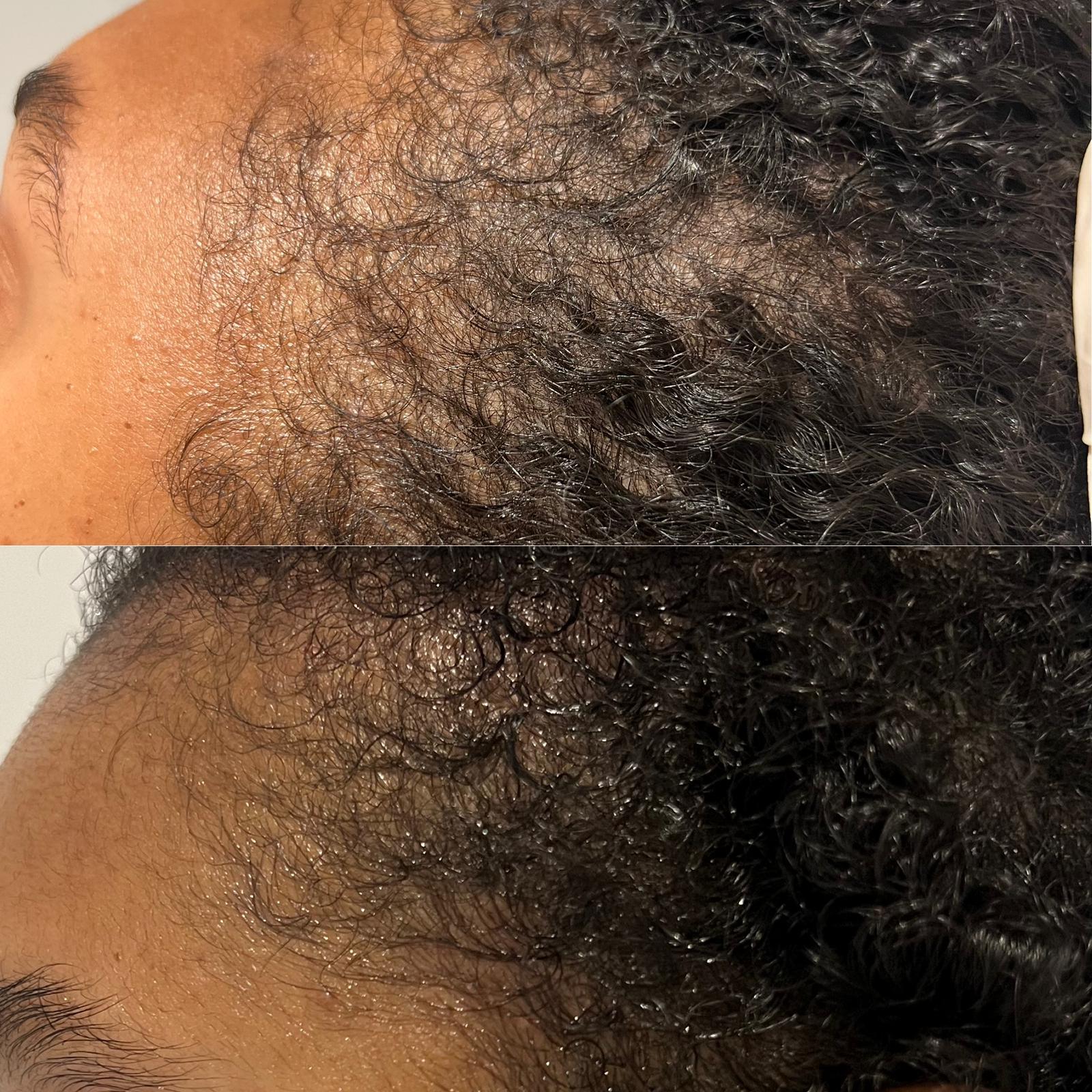 Before and after PRP and microneedling - androgenetic alopecia