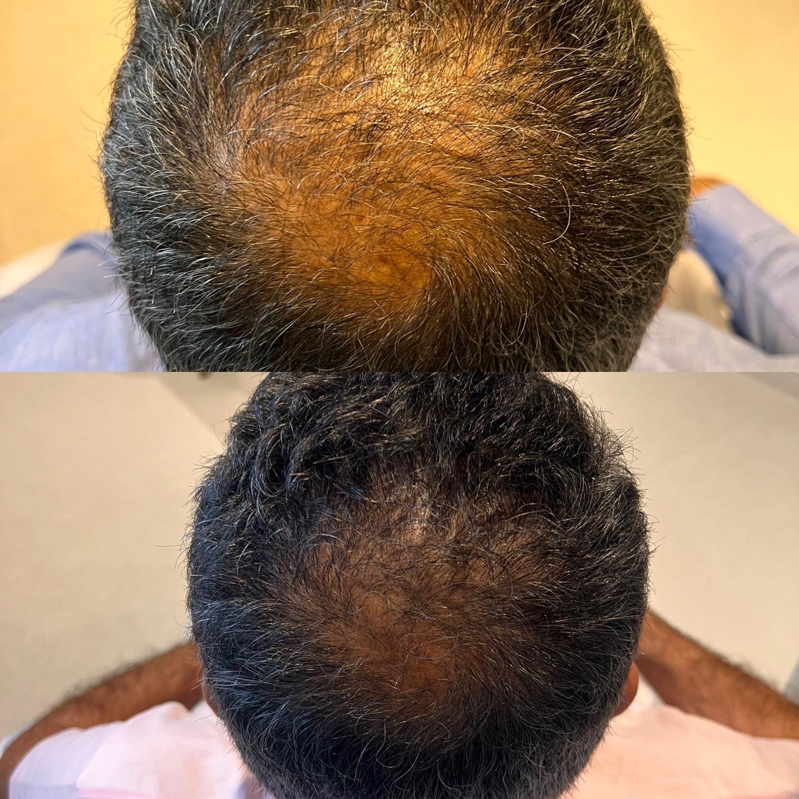 Afinamento capilar masculino na coroa antes e depois - The Scalp Labs Lisboa