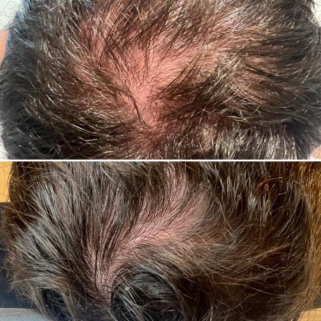 Queda difusa antes e depois de mesoterapia - The Scalp Labs Lisboa