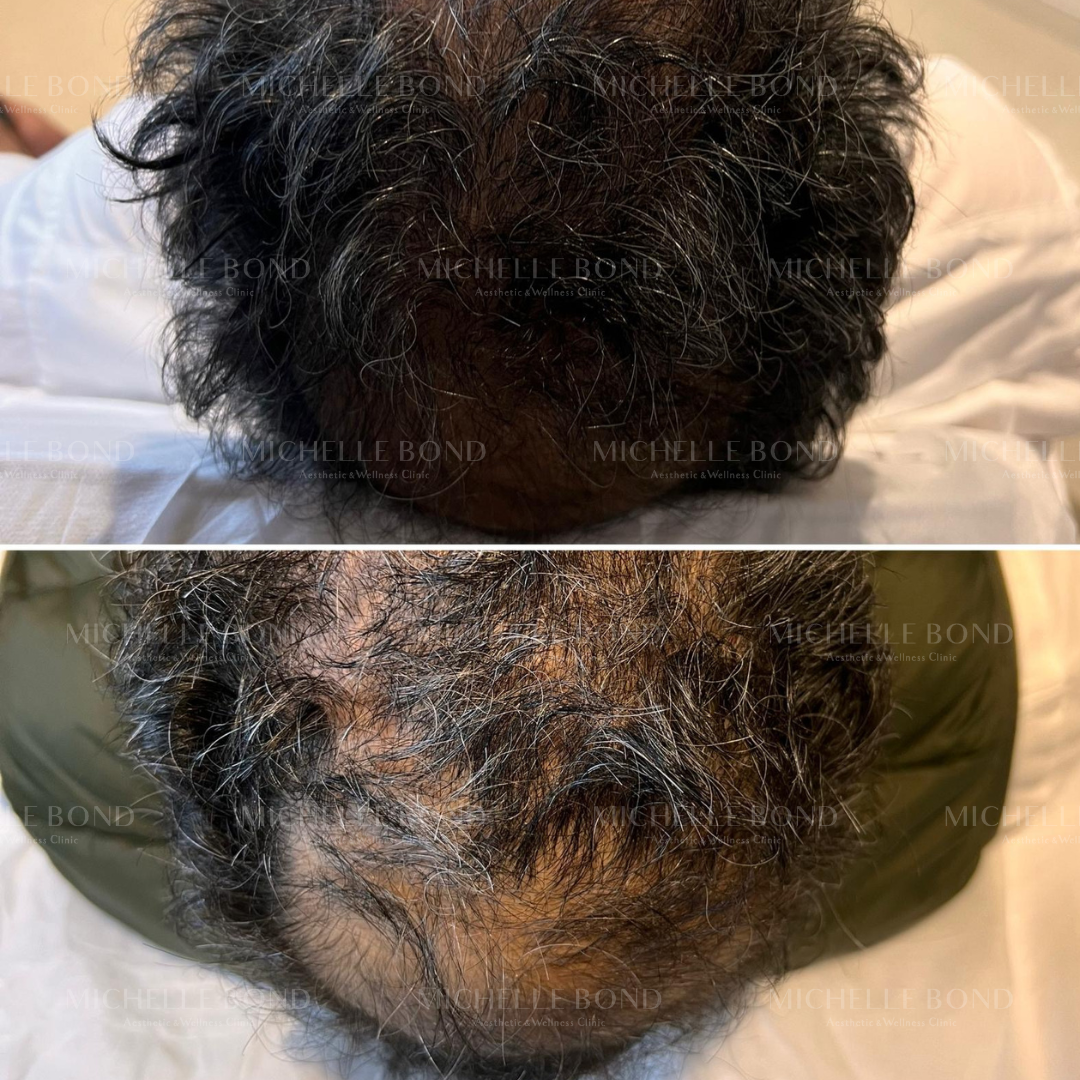 Alopecia masculina antes e depois de programa completo - The Scalp Labs Lisboa